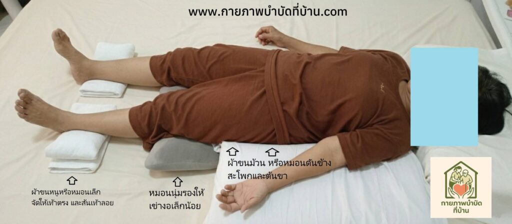 การจัดท่านอนหงายผู้ป่วย stroke ที่ถูกต้อง งอเข่าเล็กน้อย ไม่ใช้หมอนดันเท้า เพื่อลดอาการเกร็ง กายภาพบำบัดที่บ้าน