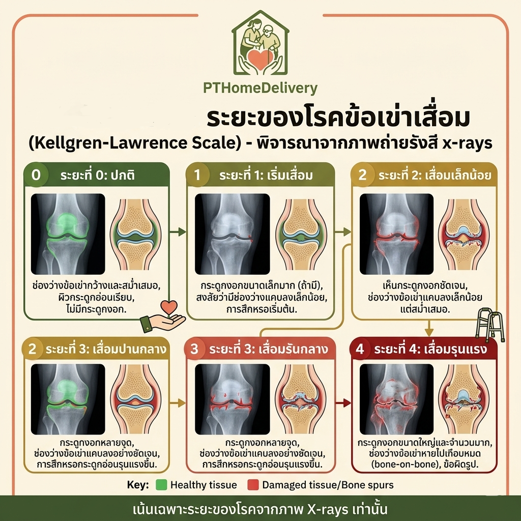 ระยะของโรคข้อเข่าเสื่อม 5 ระยะ จากภาพเอกซเรย์